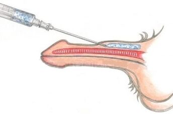 Um método perigoso de aumentar o pênis usando injeções de vaselina